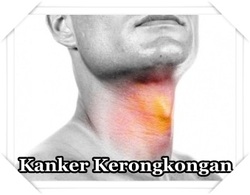 41977 small obat kanker kerongkongan herbal