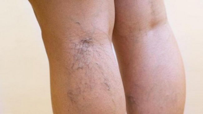 Tip Cegah Varises Pada Kaki – di Gambir, Jakarta Pusat, 11 Oct 2016